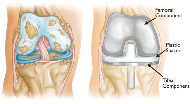 A graphic that shows what a damaged knee looks like and how an outpatient knee replacement works. The right image shows that it has a Femoral Component, a Plastic Spacer, and Tibial Component.