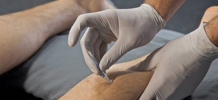 Dry Needling | Miller Orthopedic Specialists | Specializing in a wide range of orthopedic services enables Miller Orthopedic Specialists to provide personalized care plans that get patients back to optimum health.