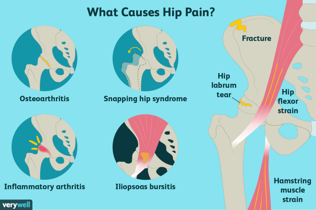 A graphic with the title of "What Causes Hip Pain?" It includes reasons such as osteoarthritis, snapping hip syndrome, inflammatory arthritis, and Iliopsoas bursitis.